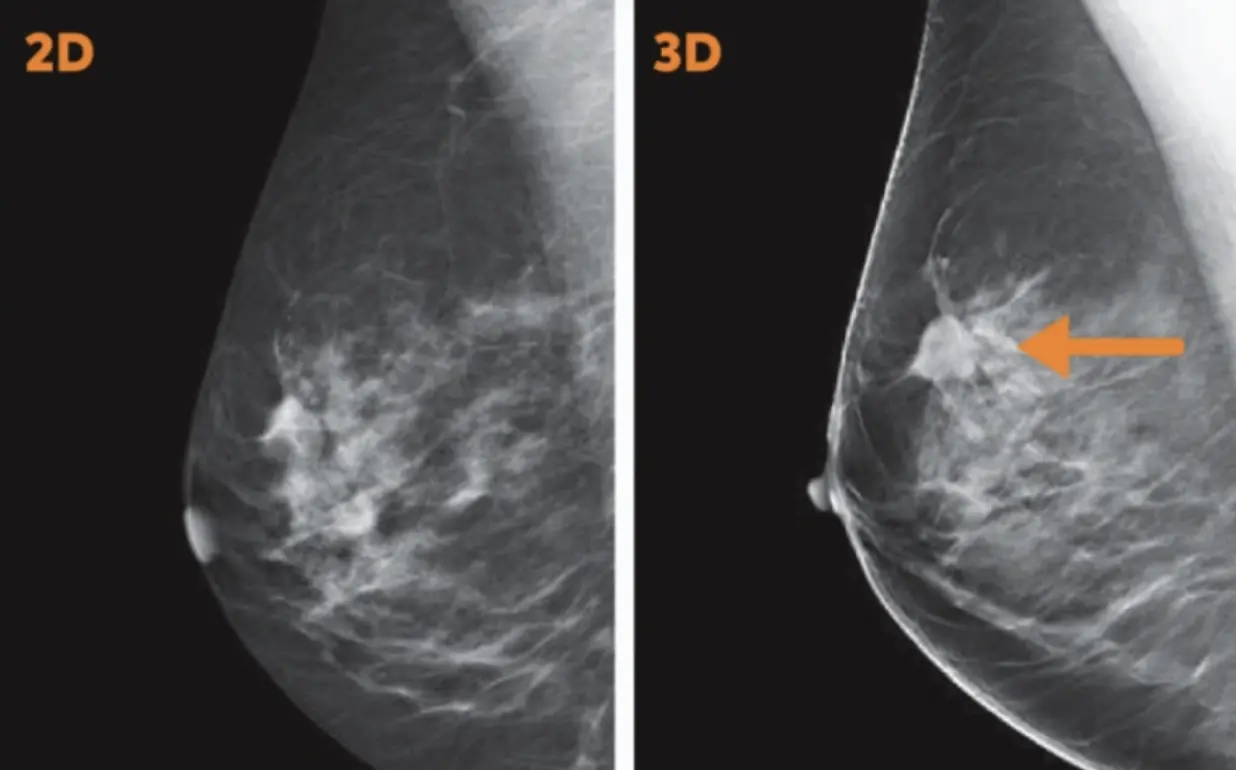 Side-by-side 2D and 3D mammograms, with an arrow marking a mass visible only on the 3D image