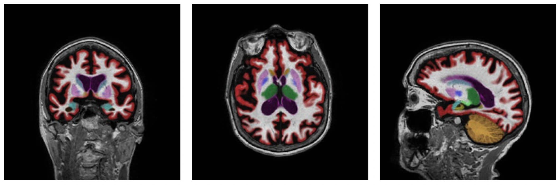 NeuroQuant image analysis in a sample report