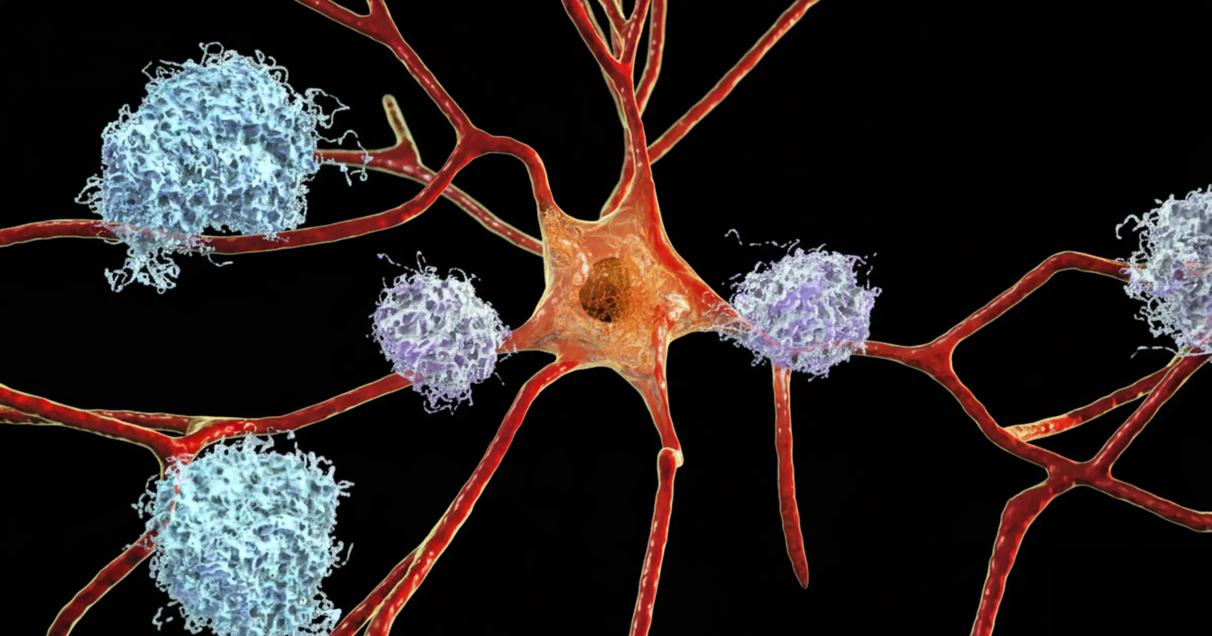 Tau tangles (orange) inside a brain cell (neuron) and amyloid plaques (blue) in the surrounding area.