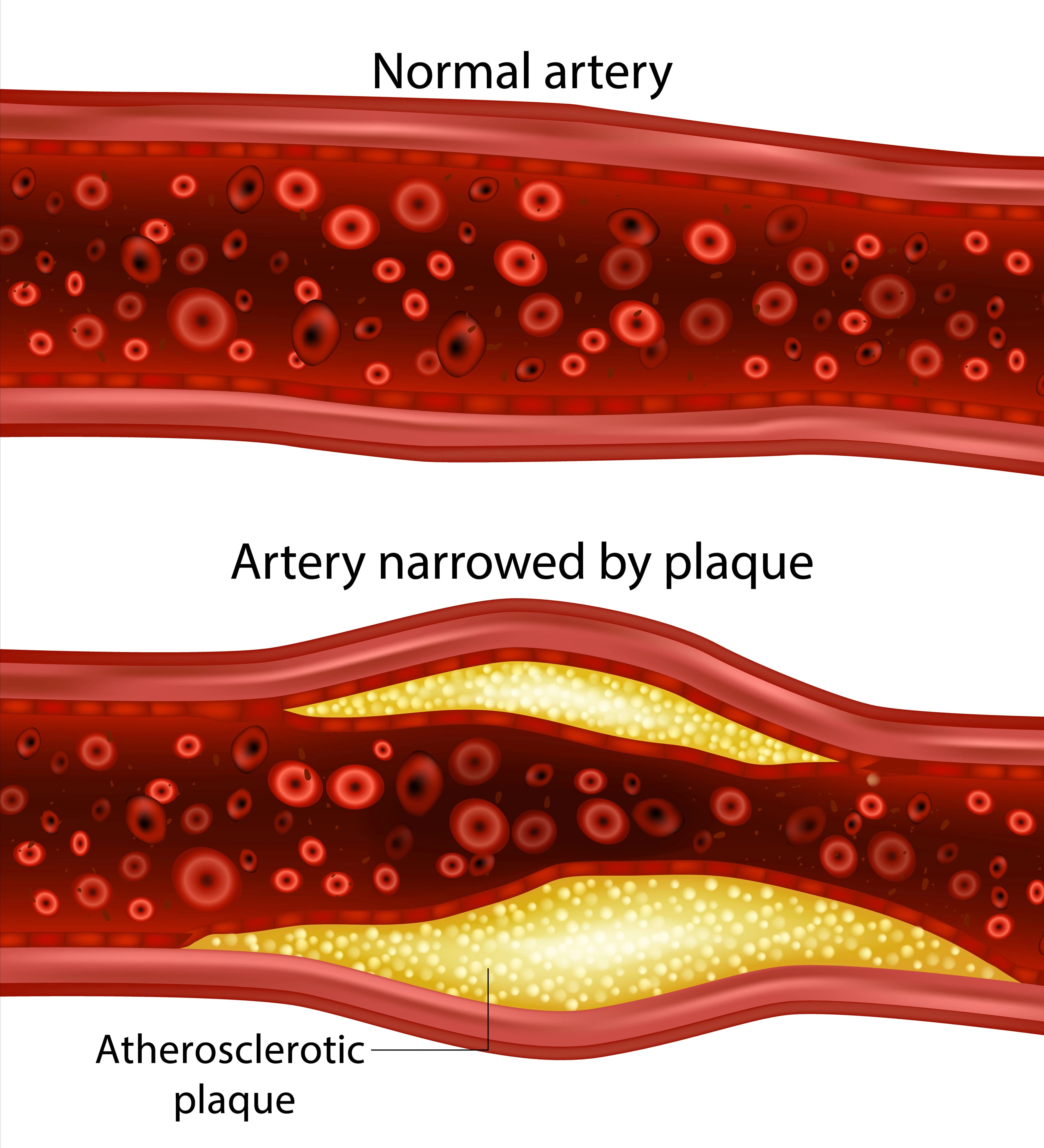Side-by-side comparison of a healthy artery versus an inflamed and calcified artery