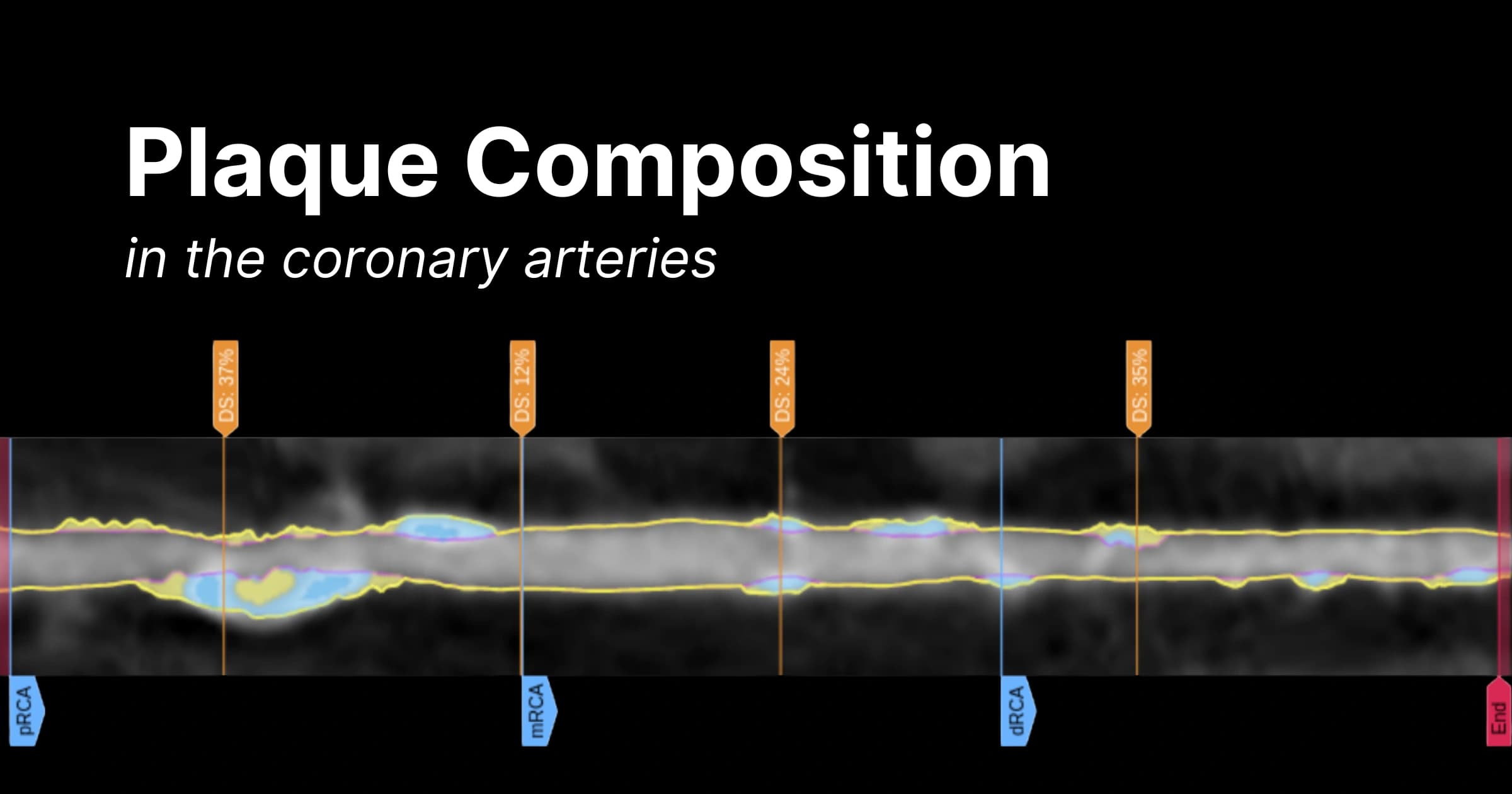 How to Aggressively Treat Dangerous Soft Plaque
