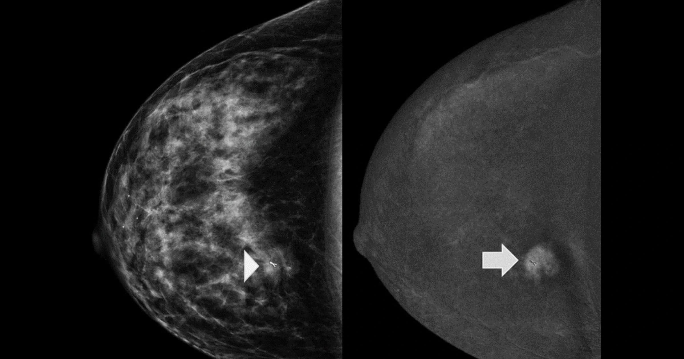 Your Mammography is Searching for Cancer in a Blizzard