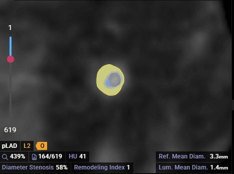 Plaque Characterization Cross Section