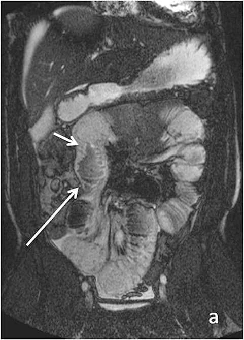 MRI imaging of the digestive system