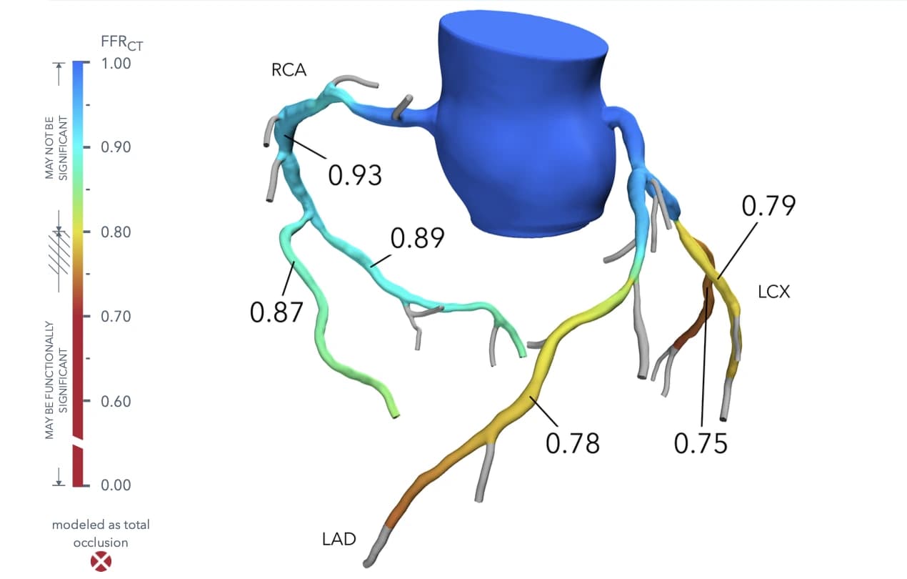 FFRct view with color-coded coronary blood flow