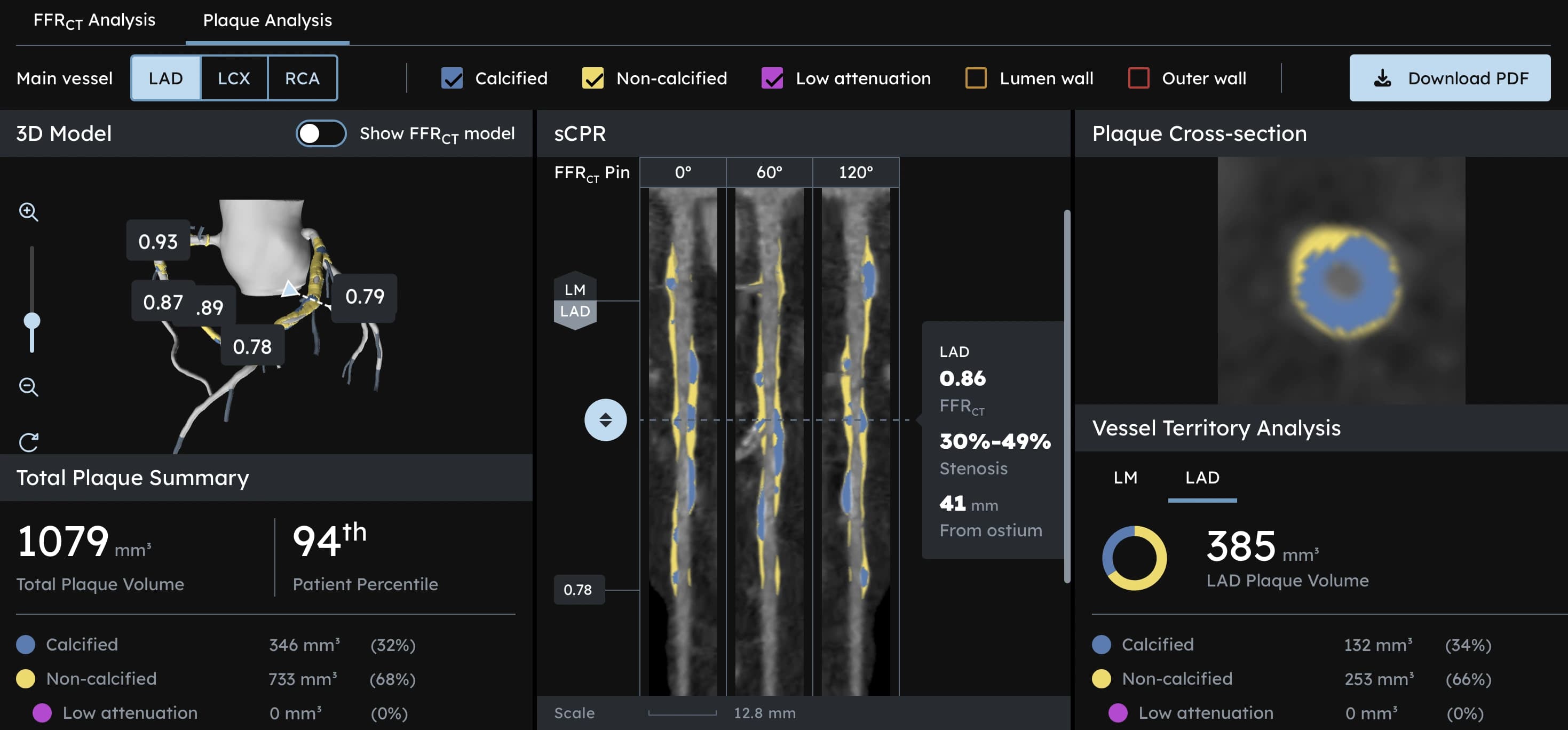 TrueScan Launches Coronary CTA with HeartFlow AI