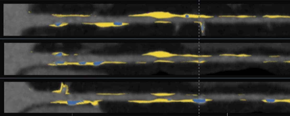Coronary Arteries