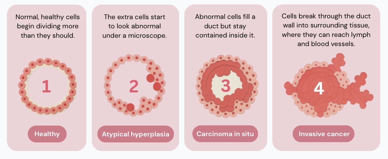 Four stages of breast cancer development: healthy duct cells, atypical hyperplasia, carcinoma in situ, and invasive cancer