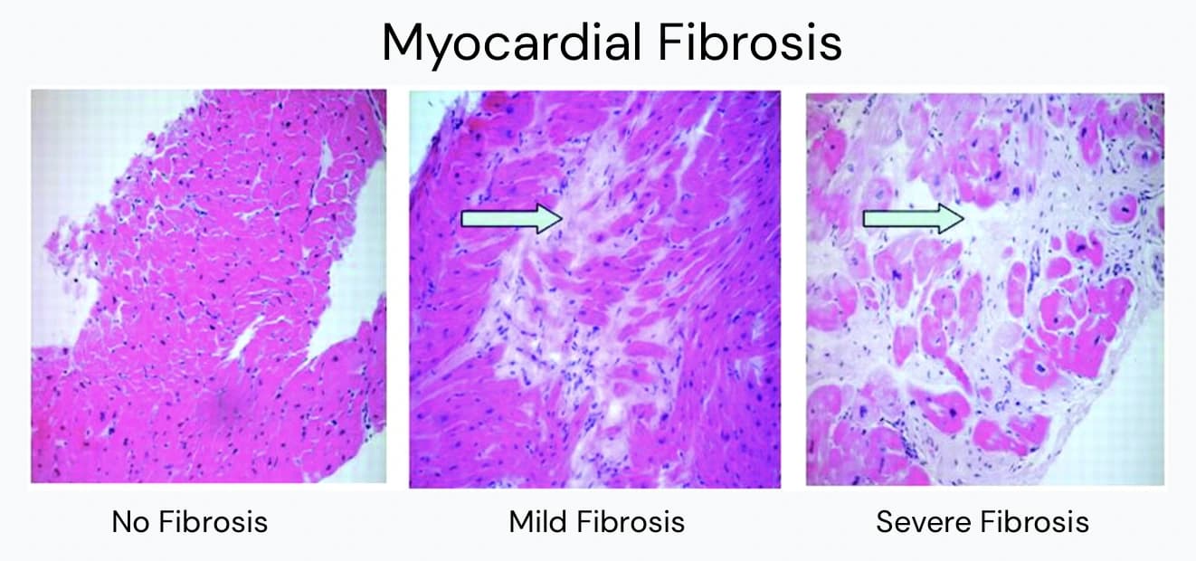 Heart muscle tissue samples showing no fibrosis, mild fibrosis, and severe fibrosis side by side