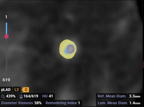 Plaque Characterization Cross Section