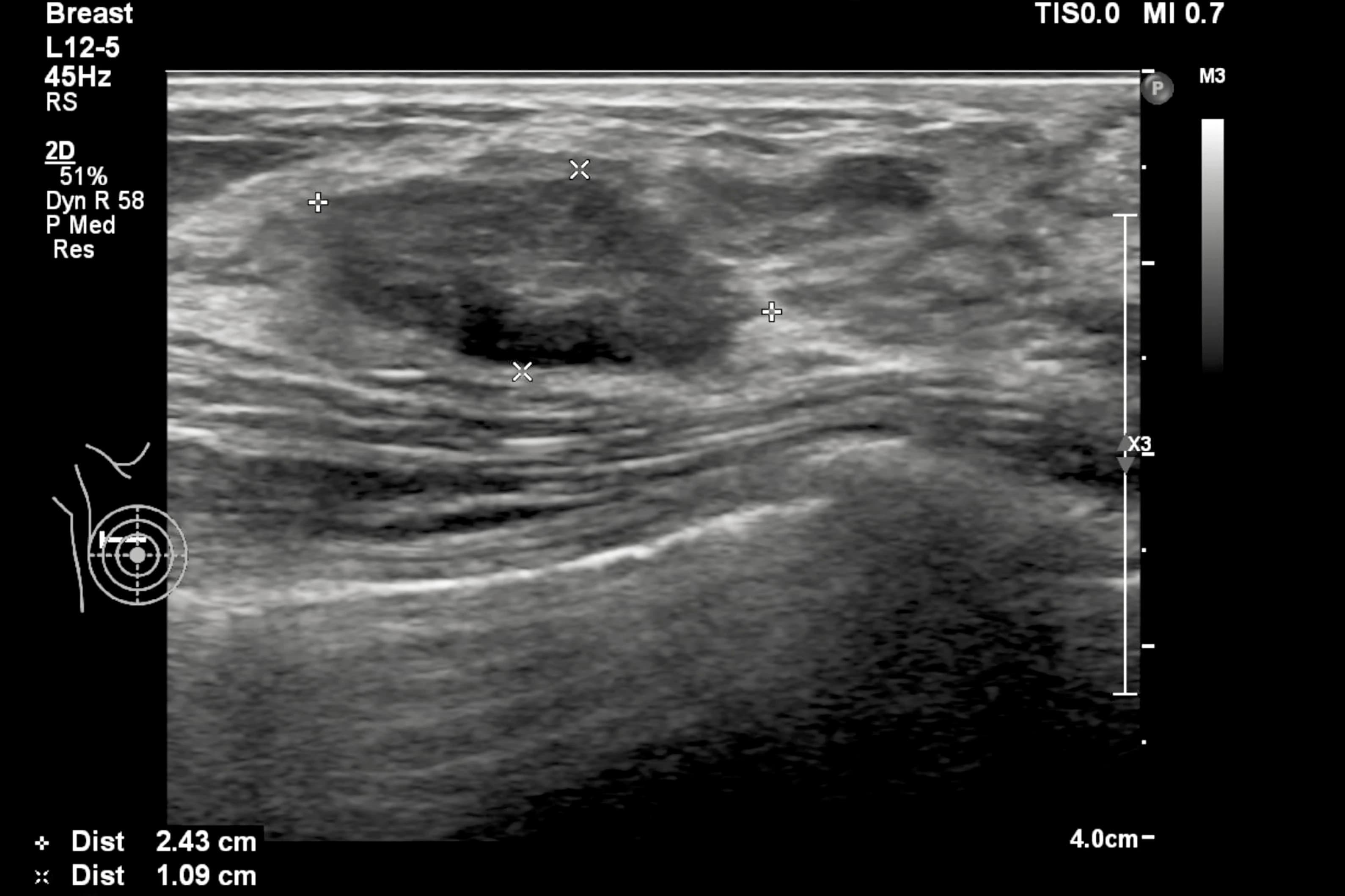 Greyscale soft-tissue ultrasound image of the breast with measurement calipers marking a lesion