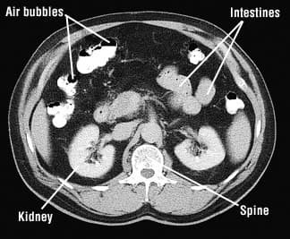 Axial CT cross-section of the abdomen with the kidneys, spine, intestines, and air bubbles labelled