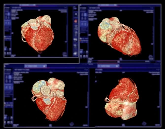 Four-panel three-dimensional CT coronary angiogram reconstruction of the heart and its coronary arteries